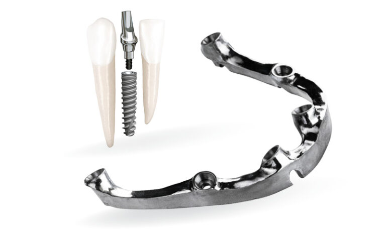 Dental Implants